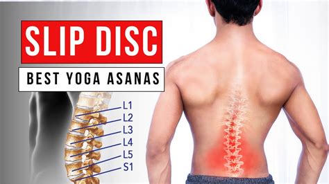 Yoga For Slip Disc Or Disc Herniation YUJX YouTube