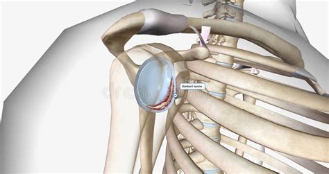 Shoulder Dislocation Anterior Dislocation Posterior Dislocation Labeled Stock Illustration