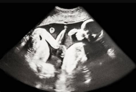 When Do Twins Show Up On ultrasound? - Ultrasound Plus