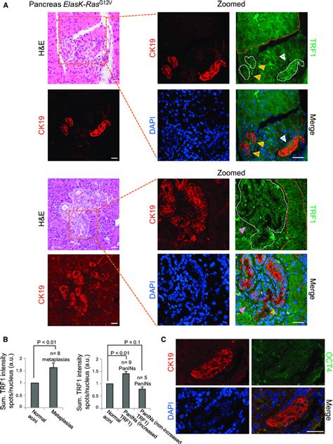 Increased Trf1 Expression In Acinar To Ductal Metaplasias And Panins Of