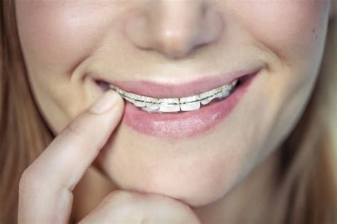 Orthodontie Chambly Pour Enfants Adolescents Et Adultes