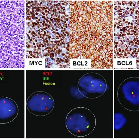 A Representative Case Of High Grade B Cell Lymphoma With MYC BCL2 And