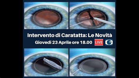 Intervento Di Cataratta Le Novit Youtube