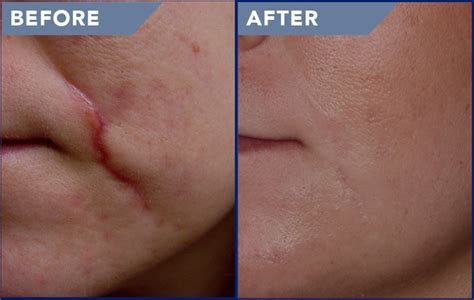 Laser Scar Removal Photos - Soderstrom Skin Institute