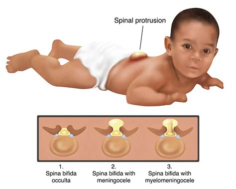 Spina Bifida Occulta In Adults Telegraph