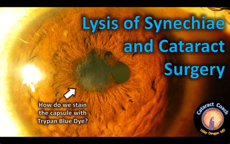 Lysis Of Synechiae And Cataract Surgery Cataract Coach