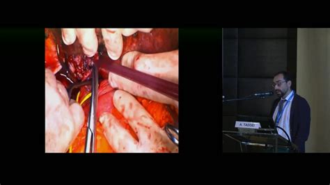 Left Hepatectomy Extended To Paracaval Segment Plus Partial