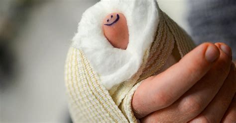 Broken Thumb Symptoms Treatment Recovery Complications And More