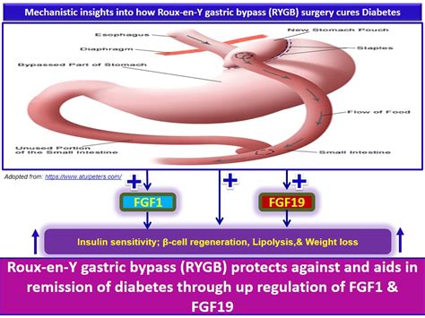 Roux En Y Gastric Bypass Diagram