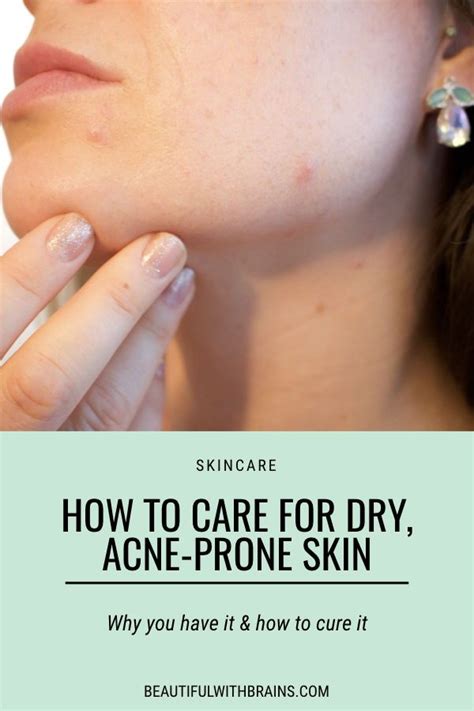 How To Deal With Acne And Dry Skin Beautiful With Brains In