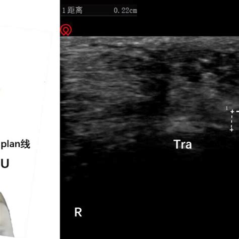 Schematic Diagram Of Probe Placement Left And Short Axis Ultrasound Download Scientific