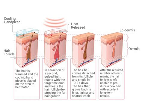 Professional Diode Laser Hair Removal Machine Newangie