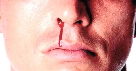 About Nosebleed Or Epistaxis Health And Medical Information