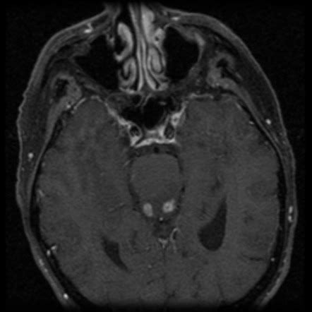 Inferior Colliculus Mri