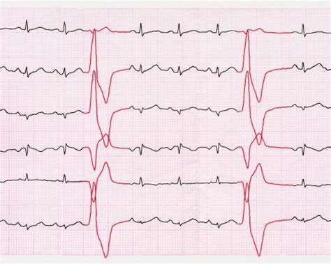 Heart arrhythmia: Diagnosis, tests, and treatment options