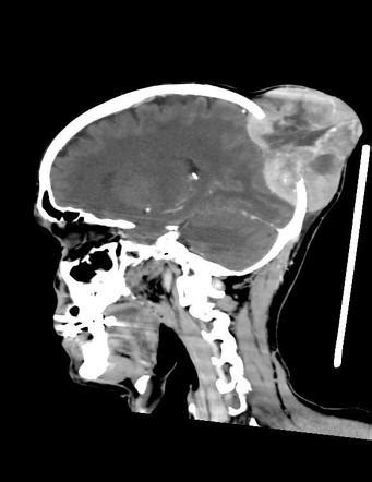 Skull Metastasis Image Radiopaedia Org