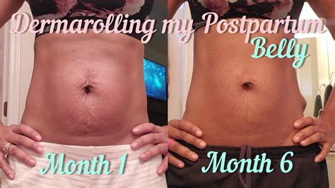 I Tried Dermarolling My Postpartum Belly Month Update On Saggy