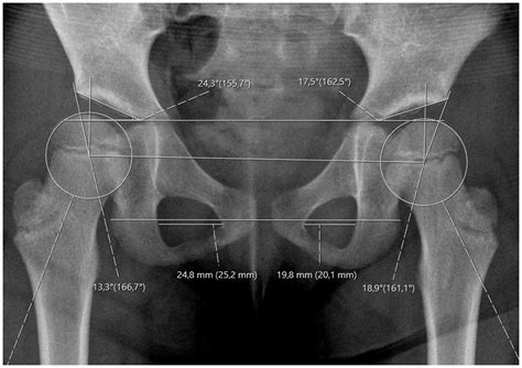 Children Treated For Developmental Dysplasia Of The Hip At Birth And