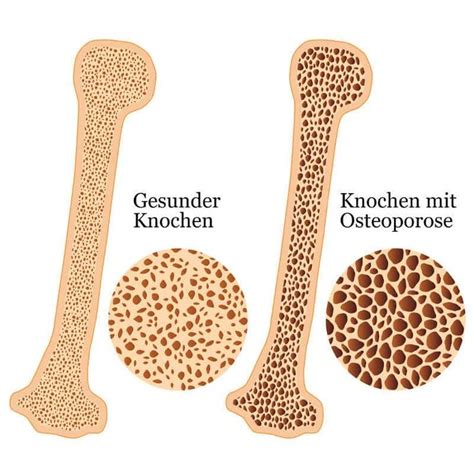 Osteoporose Das Musst Du Jetzt Wissen Vitamin D Liebscher Bracht