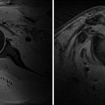 Axial And Sagittal Fat Suppressed T Weighted Mr Images Displaying