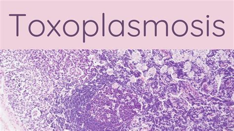 Toxoplasmosis Pathology Mini Tutorials YouTube