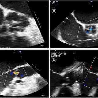 A Precardiopulmonary Bypass Midesophageal Aortic Valve Short Axis