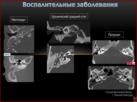 КТ-диагностика опухолей среднего и внутреннего уха