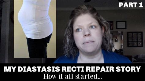 My Diastasis Recti Repair Story From Exercises To Surgery Youtube