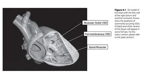 Defeito Do Septo Interventricular