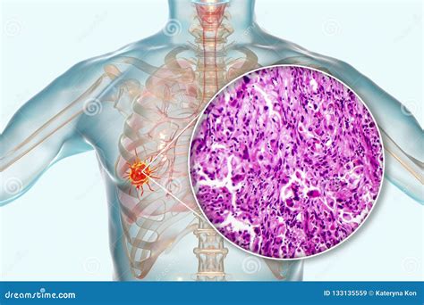 Lung Cancer, Illustration and Photo Under Microscope Stock Illustration - Illustration of ...