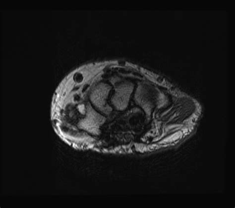 Bifid Median Nerve Image