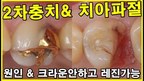 2차충치 And 치아파절 충치04강 인레이 하면 100 2차충치가 생깁니다 근데 치료안해도 됩니다 변색이니까