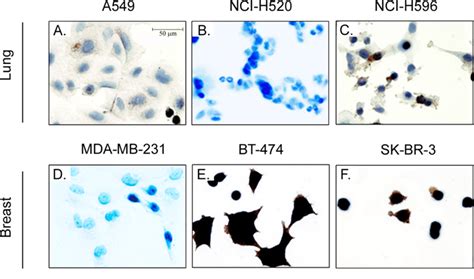 Immunohistochemical Staining Of Her2 Biomarker In Lung And Breast