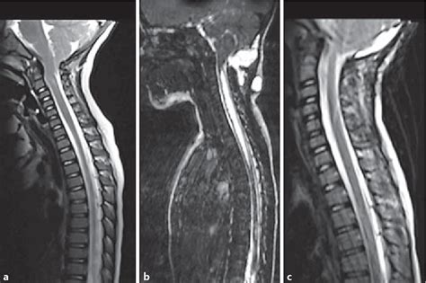 Arnold Chiari Malformation Type Iv Semantic Scholar