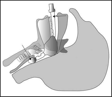 Estimation Of The Optimal Insertion Depth Of The Laryngeal Tube After