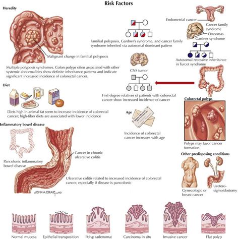 Neoplasms Of The Large Bowel Colon Polyps And Colon Cancer Clinical Tree