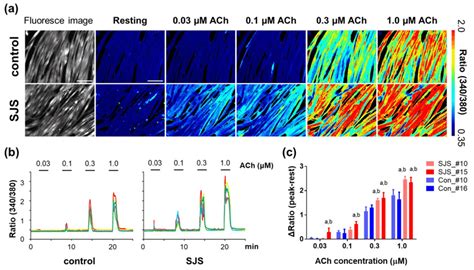Ca²⁺ Influx In Schwartzjampel Syndrome Sjs Patient Derived And