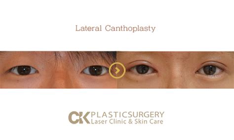 Lateral Canthoplasty Ck Plastic Surgery