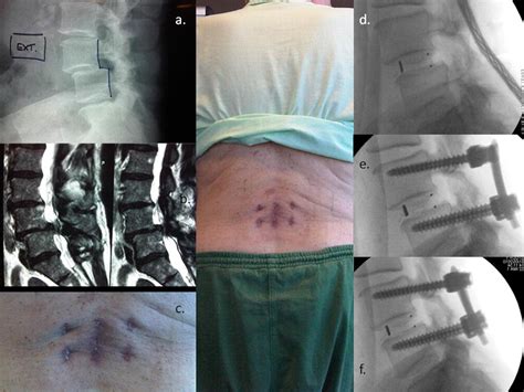 Technique Challenges And Indications For Percutaneous Pedicle Screw