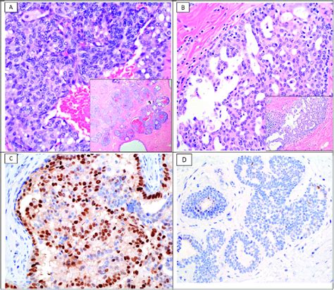 Case 1 A Ductal Carcinoma In Situ With UDH Morphology Characterized