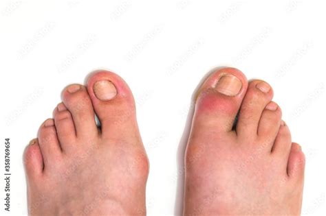 Gout Or Podagra On The Big Toe Appears As Redness And A Unbearable Pain