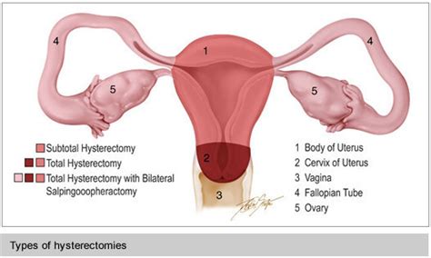 Laparoscopic And Robotic Hysterectomy Fibroid And Adenomyosis Treatment