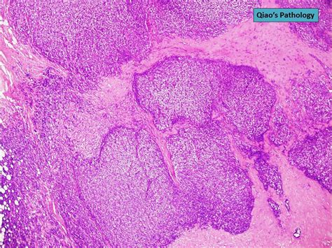 Qiao S Pathology Invasive Lobular Carcinoma With Aberrant Expression