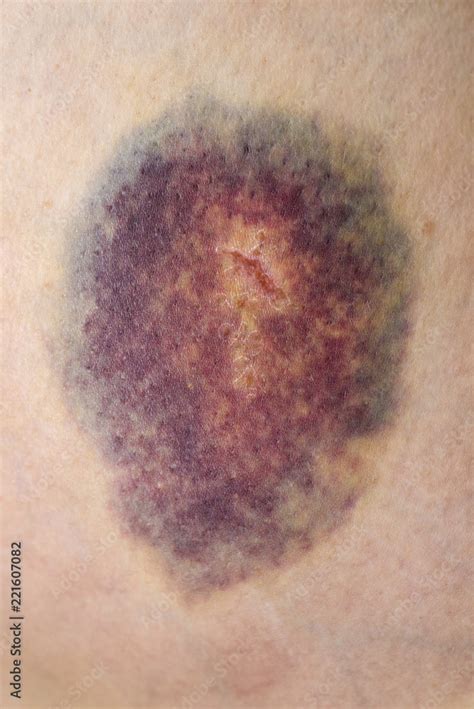 Bruise Large Bruise Injection Bruises Doctor And Patient Bruised