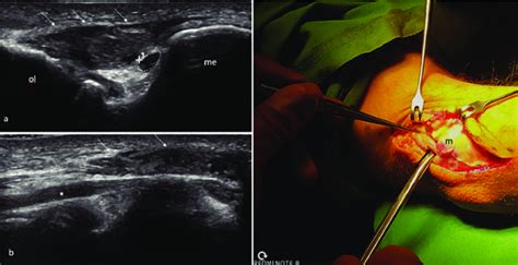 A Year Old Patient With Symptoms Of Mild Ulnar Neuropathy A Axial