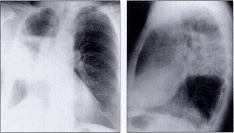 â€ Posteroanterior Andlateral Chest Radiographs Of64 Year Old Woman