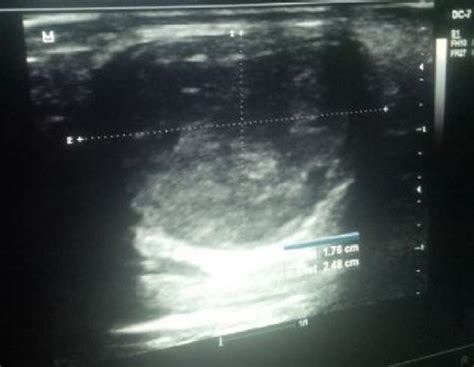 Gray Scale Ultrasound Image Showing A Partially Thrombosed