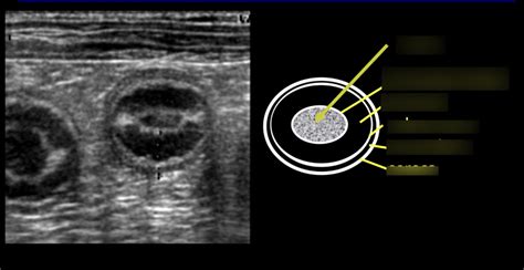 Ultrasound Study Set Small Intestine Layering Terms Flashcards Quizlet