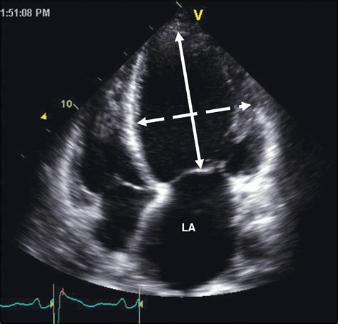 Echocardiographic Assessment Of Cardiomyopathies Thoracic Key