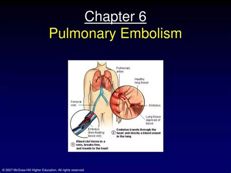 Ppt Chapter 6 Pulmonary Embolism Powerpoint Presentation Free Download Id 5190931